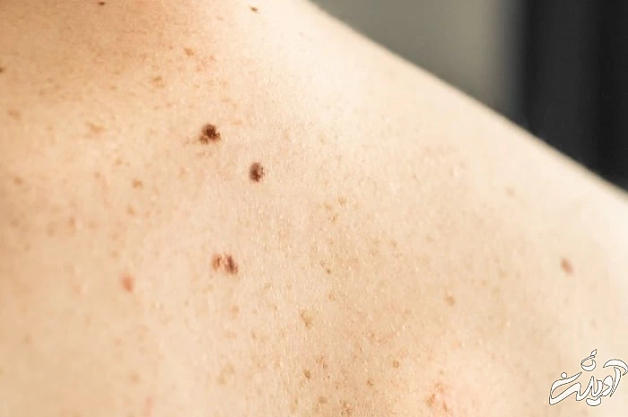 بیماری آدیسون